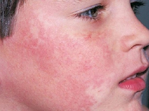 A escarlatina, uma infecção bacteriana causada por estreptococos do grupo A, atinge principalmente crianças com idade entre 5 e 12 anos. Os sintomas incluem dor de garganta, dor de cabeça, febre e uma textura áspera e vermelha da pele na região do peito e do estômago, que pode se espalhar para outras partes do corpo.