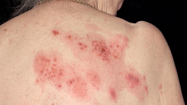 Herpes-zóster: conhecida popularmente como cobreiro, a virose causa queimações ou coceiras na pele, seguidas por erupções de bolhas cheias de líquido