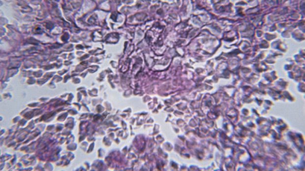 Imagem microscópica de uma infecção secundária por aids