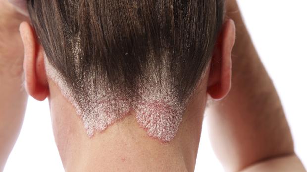 A psoríase é uma doença inflamatória, crônica e não contagiosa da pele