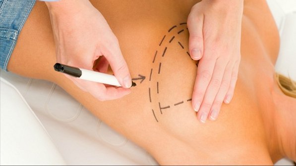 SUS amplia acesso à cirurgia de reconstrução mamária para além dos casos de câncer