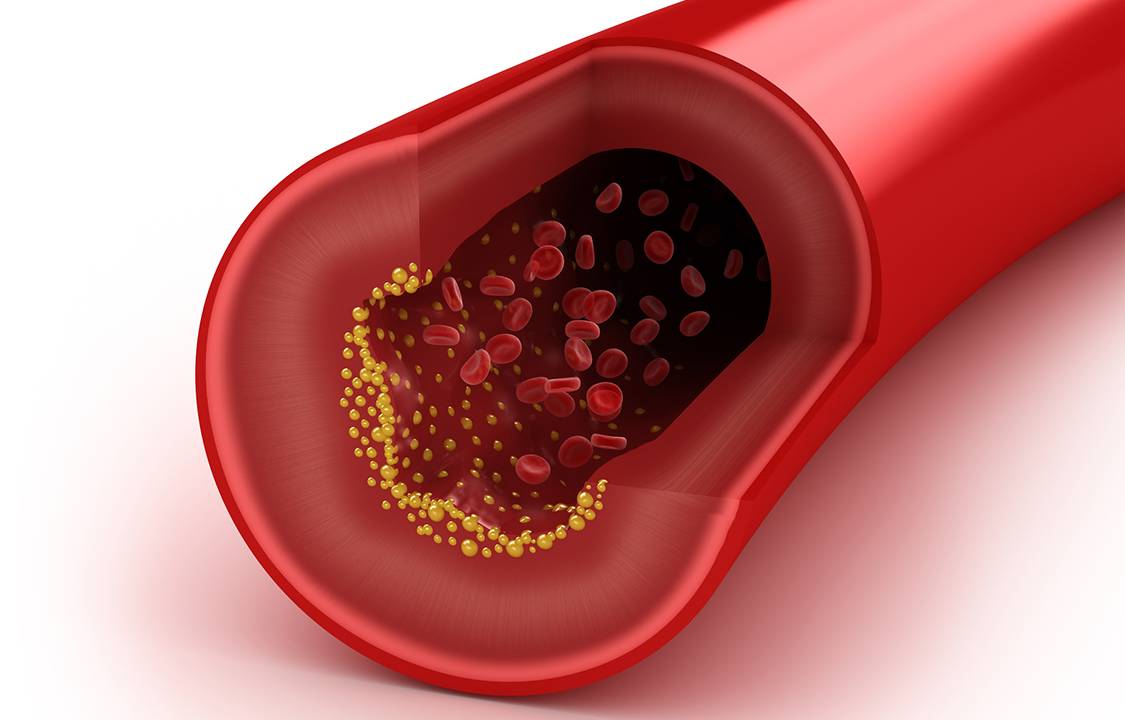Cholesterol plaque in artery, concept isolated on white