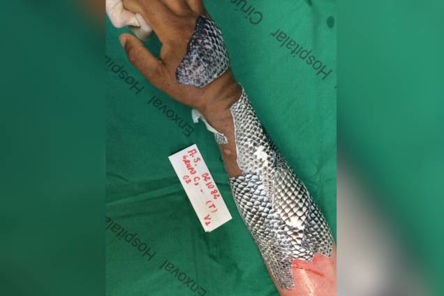 Colocação da pele para tratamento das queimaduras em pacientes do Instituto José Frota, em Fortaleza. Colocação da pele para tratamento das queimaduras em pacientes do Instituto José Frota, em Fortaleza.