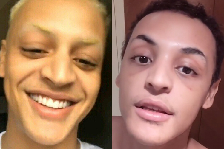 Pabllo Vittar retira curativos após cirurgia