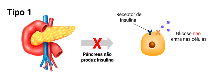 No diabético tipo 1, o pâncreas deixa de produzir insulina, o que impede que o açúcar chegue às células