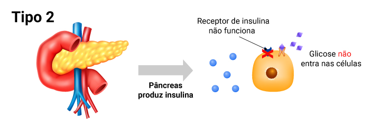 No diabetes tipo 2, quando a pessoa engorda, as células de gordura se acumulam no abdômen, prejudicando a ação da insulina. A pessoa se torna “resistente à insulina”, o que dificulta a entrada da glicose nas células. Nesse momento, o pâncreas percebe a dificuldade do transporte do açúcar e começa a produzir mais insulina, até ficar sobrecarregado e começar a falhar.