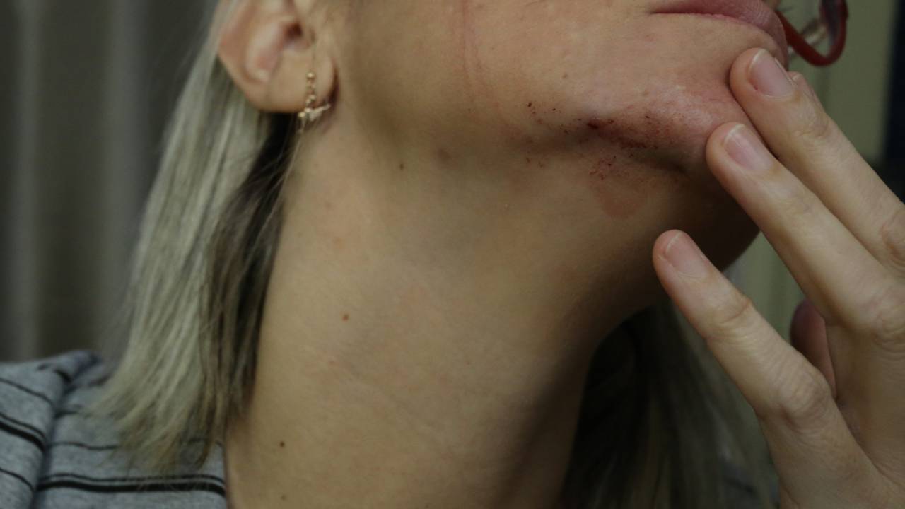Jornalista vítima de agressão por militantes de Bolsonaro no Recife - 7/10/2018