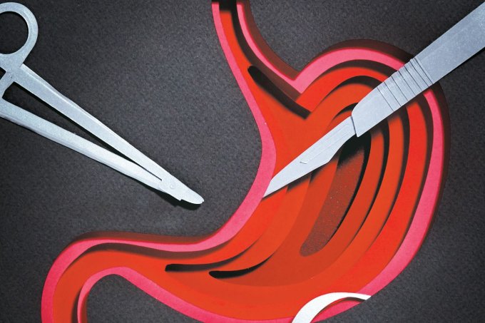 A terapia que devolveu a esperança para curar o câncer de estômago