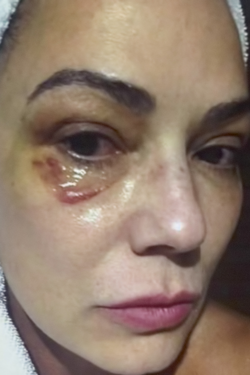 LUIZA-BRUNET-SOCO-2016-500.jpg VIOLÊNCIA - Marcas: em 2016, a modelo tornou pública a agressão que sofreu -