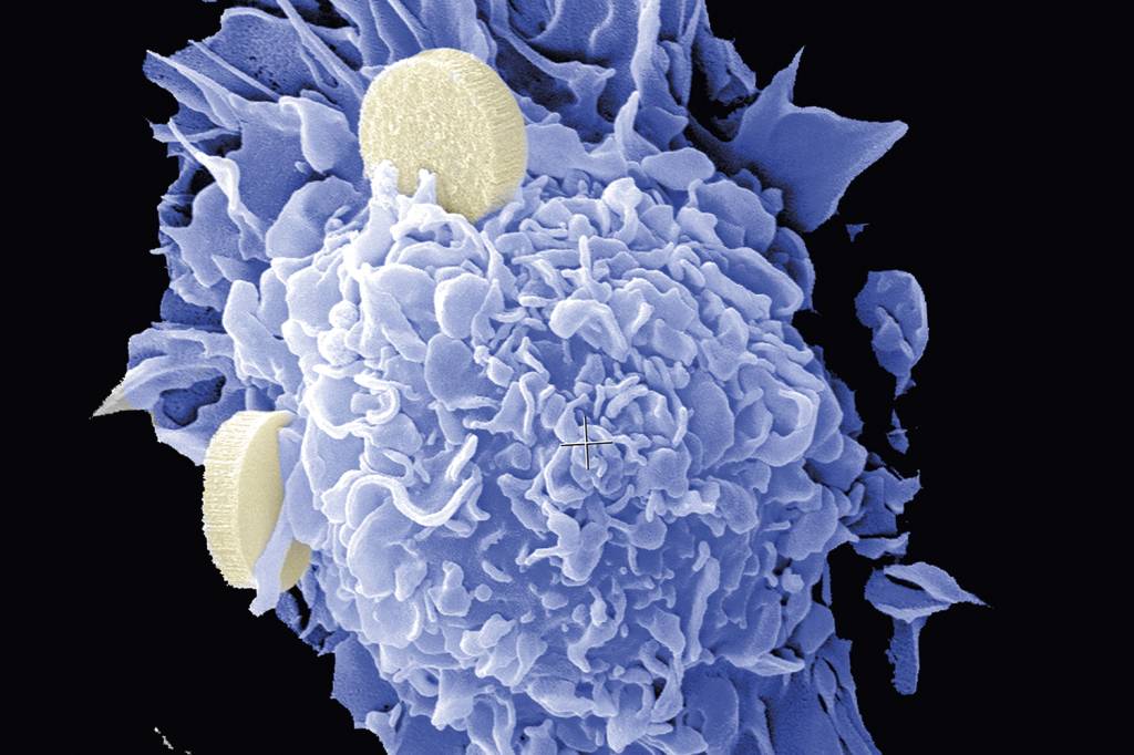 NANOMEDICINA-CANCER-VACINA-2.jpg AÇÃO - Nanovacina (em azul): o antígeno estimula uma resposta do organismo -