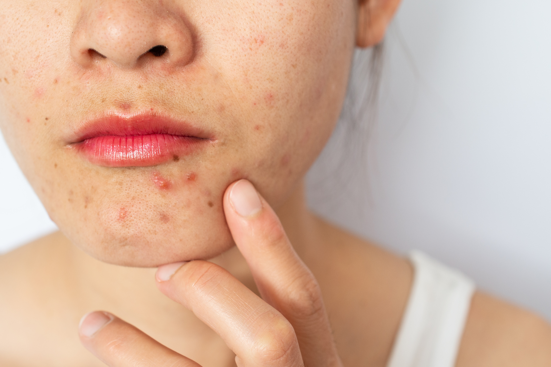 Headshot of woman face with problems of acne Inflamed (Papule and Pustule) occur on her skin.