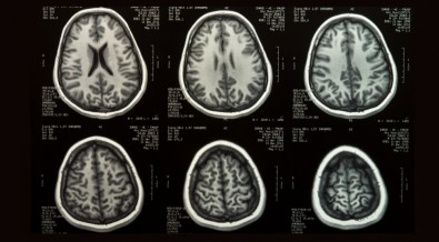 Doença de Parkinson: nova pesquisa abre caminho para o tratamento com células-tronco