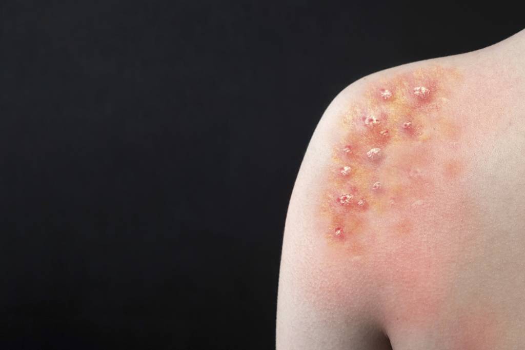 Varíola dos macacos é detectada em crianças nos EUA e na Holanda