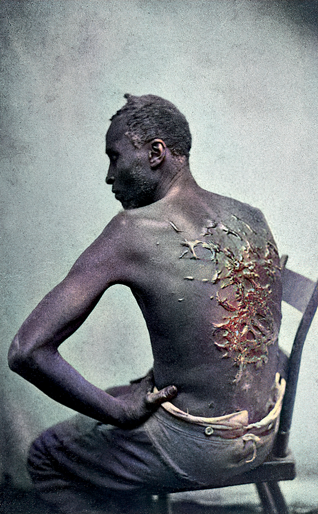 Rear View of Former Enslaved Man Revealing Scars at Medical Inspection CHOCANTE - A foto célebre das cicatrizes de Peter: realidade cruel -
