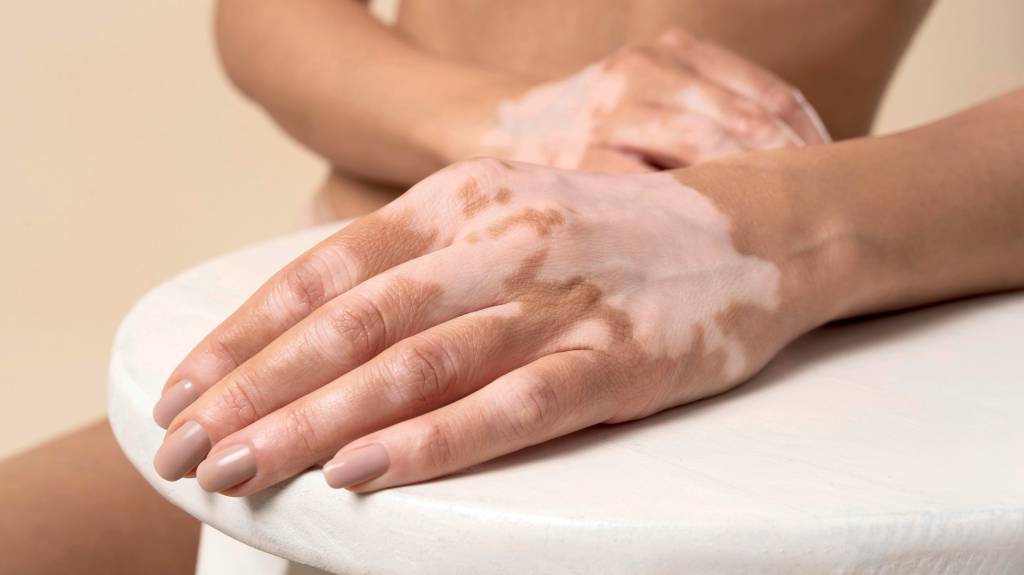 Young,Woman,With,Vitiligo,Posing ALÉM DA GENÉTICA - Vitiligo: condição pode se manifestar após traumas