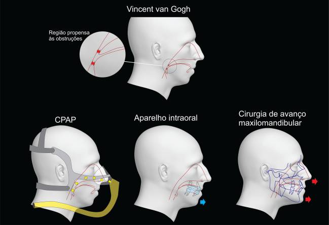 a face em perfil de van Gogh salientando a região onde ocorrem os colapsos que obliteram a via aérea de forma total (apneia) ou parcial (hipopneia) -