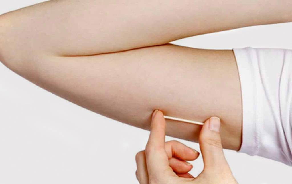 Implante contraceptivo que custa até R$ 4 mil é incorporado no SUS