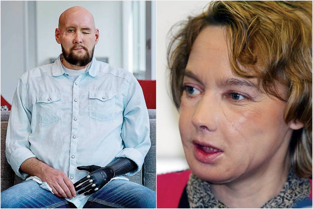 2—TRANSPLANTE-FACE-OLHO—AARON-JAMES-a RECOMEÇO -Pioneiros: o americano Aaron James recebeu parte do rosto e um olho; a francesa Isabelle Dinoire foi a primeira paciente da história