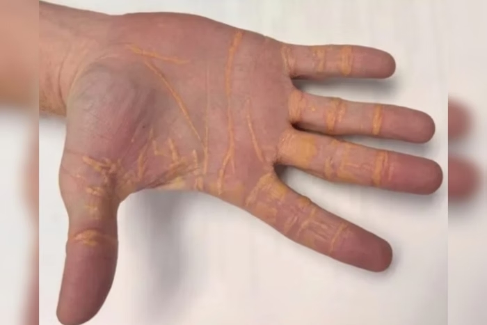 Mão com sinais de xantelasma -