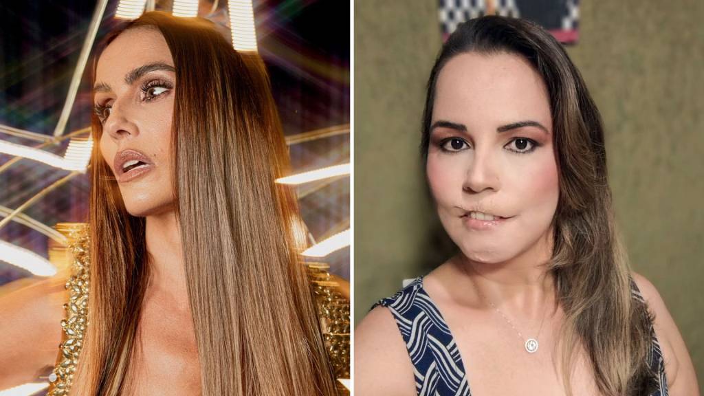 654353643 ARREPENDIMENTO - A atriz Deborah Secco (à esq.) e a influenciadora Mariana Michelini: a primeira reverteu um procedimento; a segunda perdeu parte dos lábios
