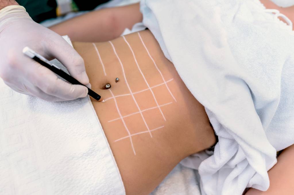 Doctor draw correction lines on woman’s stomach FEBRE - Mais e mais clínicas: a procura cresceu tanto para os procedimentos cirúrgicos quanto para os menos invasivos