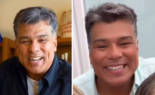 Antes e depois da harmonização facial de Maurício Mattar