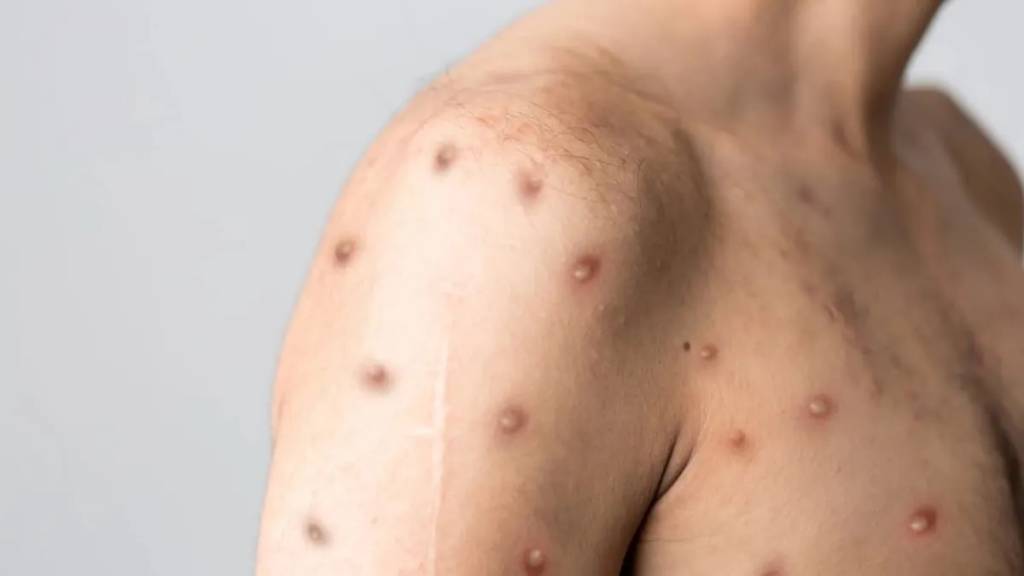 Mpox: novo estado confirma doença viral e número de casos no Brasil se aproxima de 150