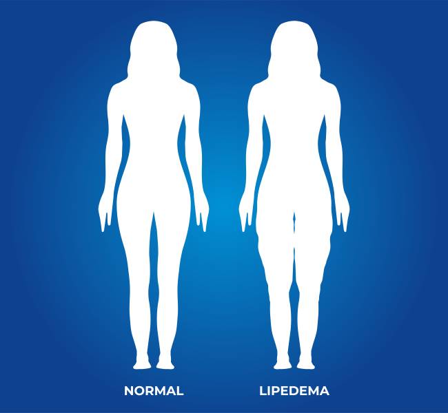 Woman Illustration Silhouette with Normal and Lipedema Legs lipedema
