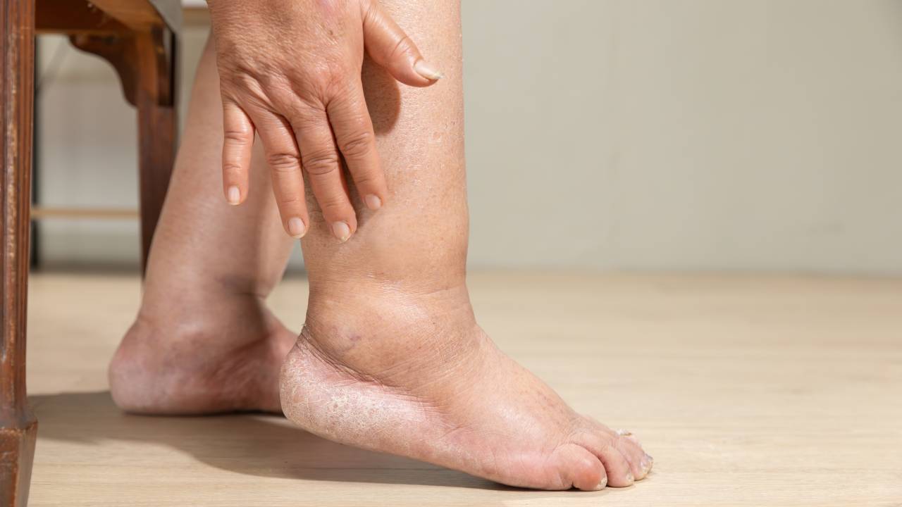 lipedema-edema