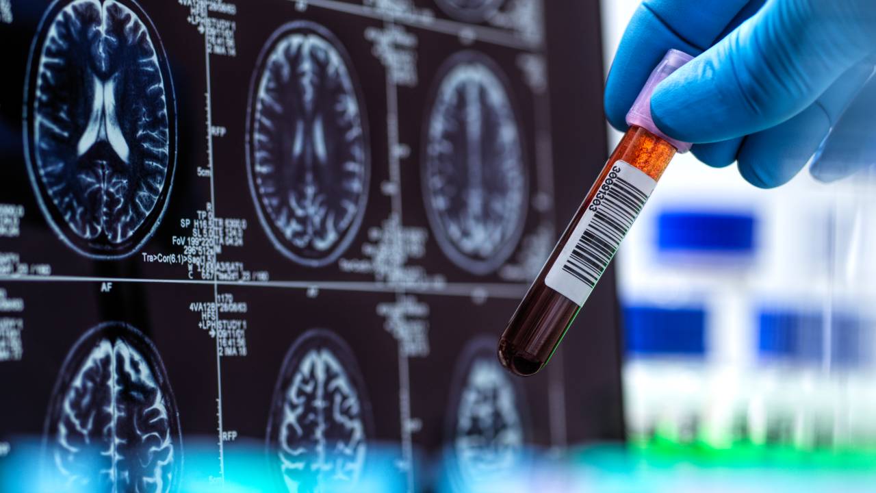 ALZHEIMER - Exame: teste brasileiro ajuda a primorar diagnóstico