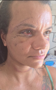Rosto da mulher que levou 61 socos do namorado em Natal sete dias após a cirurgia de reconstrução facial
