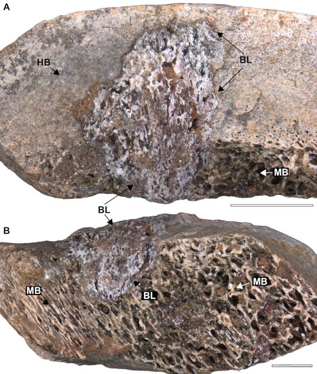No osso fossilizado de cerca de 80 milhões de anos, as setas indicadas por BL apontam a lesão causada por osteomielite. HB é a parte não lesionada e MB é a medula óssea
